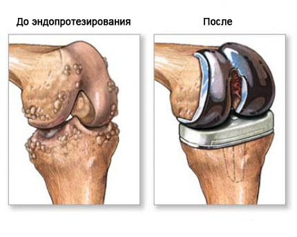 Предотвратяване и лечение на артрит на колянната става