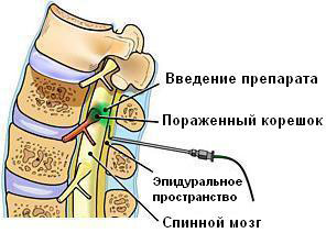 Стеноза на гръбначния канал: причини, симптоми, тактики на лечение