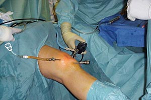 Артроскопия на колянната става: последици и рехабилитация след процедурата