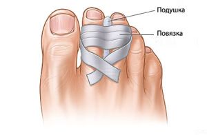 При първите симптоми на счупено пръст е необходимо незабавно лечение