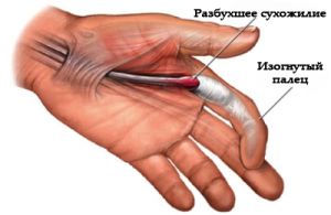 Причини и лечение на stenosing ligamentitis (счупване на пръста синдром)