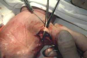 Причини и лечение на stenosing ligamentitis (счупване на пръста синдром)