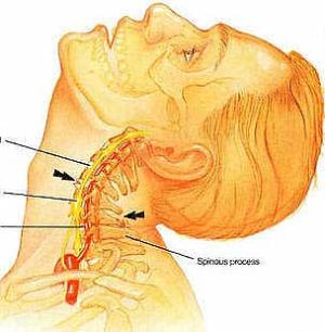 Диагностика на цервикалгия: симптоми и лечение на болка в областта на шията