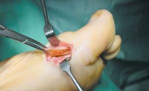 Медицина и хирургическа корекция на валгусната деформация на палеца