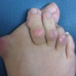 Характеристики на деформациите на крака на валгус при деца: симптоми, лечение и профилактика