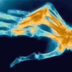 Как и как да се лекува полиартрит в ръцете