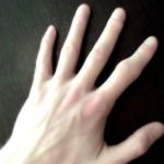 Как да се излекува силната синина на пръста и да не се предизвикват усложнения