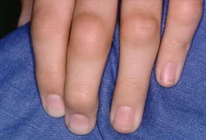 Как ефективно да се лекува полиартрит на пръстите