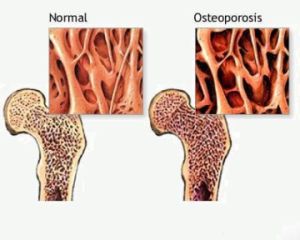 Как да идентифицираме и лекуваме остеопорозата