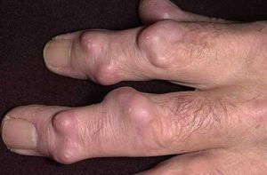Хигрома на пръста не е изречение - ефективни методи за лечение и фото патология
