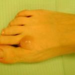 Хигрома на пръста не е изречение - ефективни методи за лечение и фото патология