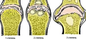 Възможно ли е лечение на ганартроза на колянната става от 3-та степен и защо се получава увреждане?