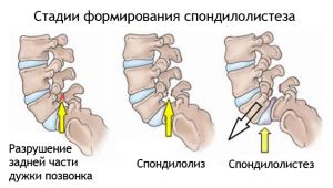 Spondylolysis и spondylolisthesis на лумбалния гръбначен стълб