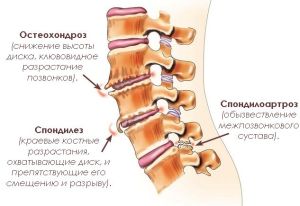 Спондилоза на лумбалния гръбначен стълб: превенция и лечение