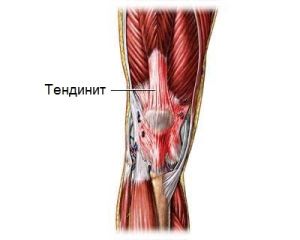 Основните симптоми и лечение на коленните тендонити