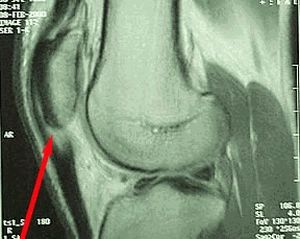 Основните симптоми и лечение на коленните тендонити