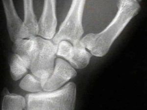 Лечение и рехабилитация след счупване на скуоидната кост на ръката