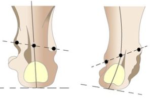 Varus деформация на долния крак при възрастни и деца