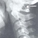 Какво причинява разцепване на гръбначния стълб (Spina bifida)