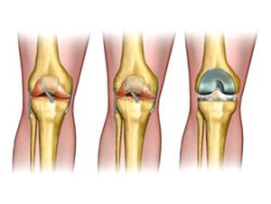 Какво трябва да знаете за операцията за подмяна на коляното: обучение и рехабилитация