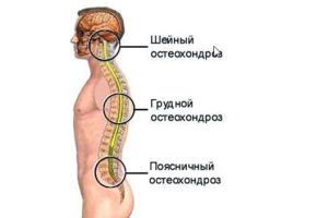 Подход за лечение на остеохондроза на гръдния кош