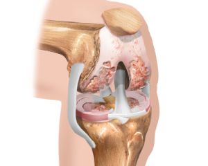 Artrodes - функционално обездвижване на ставите