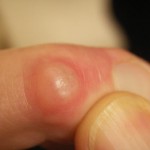 Растеж върху пръстите на ставата и китката: лечение и отстраняване