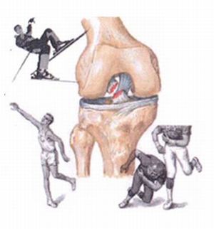 Причините и методите за лечение на нестабилност на колянната става