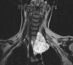 Хордом: тумор на гръбначния стълб и основата на черепа