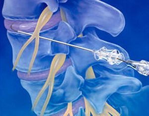 Студената плазмена нуклеопластика е нововъведение в лечението на херния на гръбначния стълб