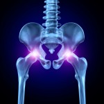 Унищожаване на ставите (бедрена кост, коляно): симптоми и лечение