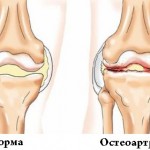 Унищожаване на ставите (бедрена кост, коляно): симптоми и лечение