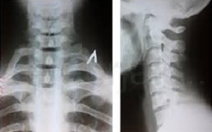 Изкривяване - опасна травма на гръбначния стълб с тежки последици