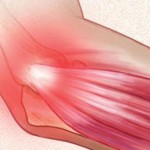 Епикондилит на лактите: как да се лекува възпаление (мехлеми, упражнения), причините и признаците на заболяването