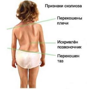 Характеристики на лечението на сколиозата на лумбалния гръбначен стълб