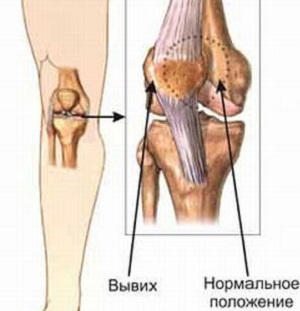 Първа помощ и лечение за разместване на коляното