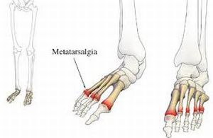 Болка на краката от различен произход или метатарсалгия