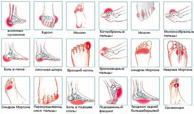 Болка на краката от различен произход или метатарсалгия