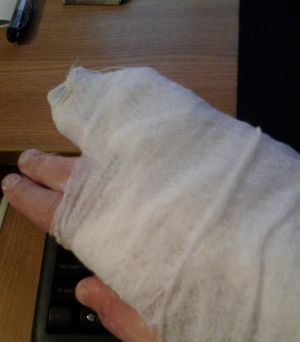 Фрактура на малкия пръст на ръка: травмата не е много опасна, но неприятна