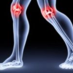 Гонартроза на колянната става 1 градус - когато болестта все още може да бъде спряна