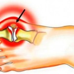 Духов артрит: симптоми и лечение на остра форма с подагра