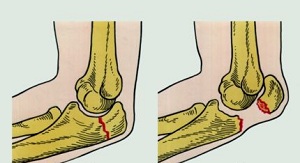 Как да излекувате и развиете ръка след счупване на лакътната става