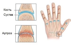 Как да се лекува артроза на пръстите с помощта на традиционната и народната медицина