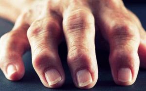 Как да се лекува артроза на пръстите с помощта на традиционната и народната медицина