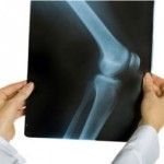 Как да се лекува периартрита на колянната става
