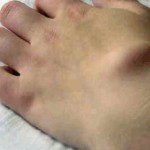 Хигрома на глезена: Лечение на сухожилията на крака