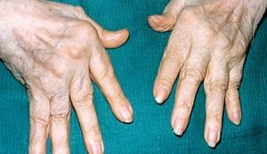 Ако връзките задържат ревматоиден артрит: симптоми и лечение