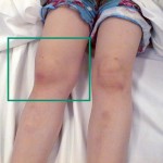 Младежки ревматоиден артрит: причините за диагнозата, симптомите (снимка) и лечението при деца