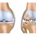 Гонартроза на колянната става на трета степен (двустранна): увреждане и лечение