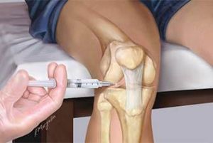 Хемартроза на колянната става: симптоми и лечение